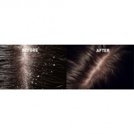 Rosinii Scalp Expert Salicylic Acid + Niacinamide Oily Scalp & Dandruff Treatment  Scalp Expert Салициловая кислота + ниацинамид для жирной кожи головы и против перхоти