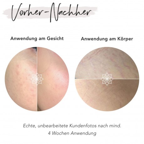 FACES OF FEY Microneedlingset Basic Hyaluron 0,25mm  Набор для микронидлинга Basic Hyaluron 0,25 мм